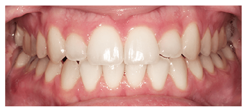 After Six Month Smiles Treatment at Dental Touch