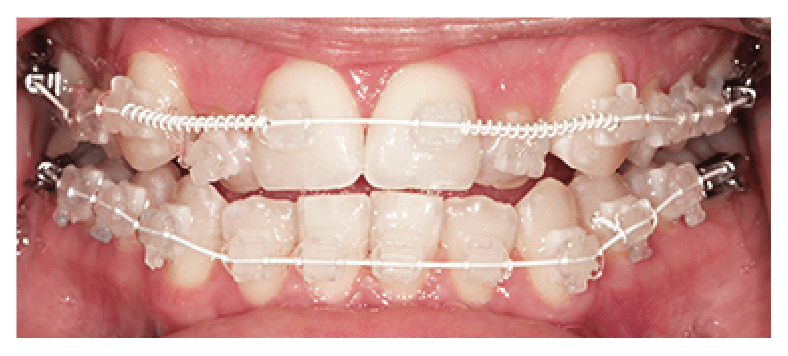 During 6 month smiles treatment Britol