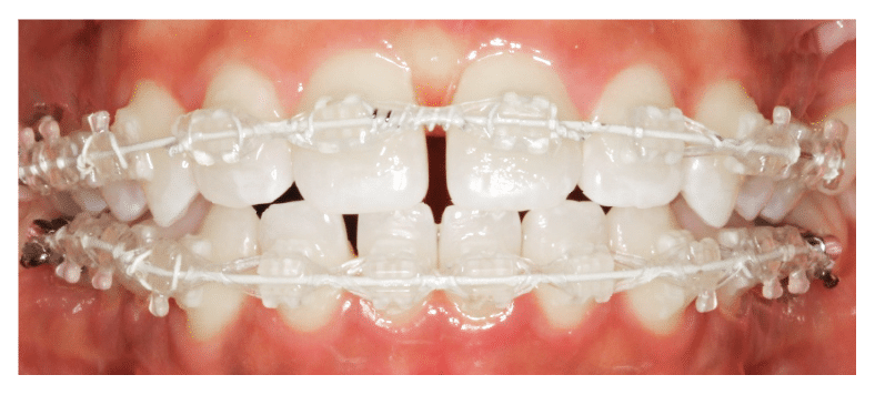 During 6 month smiles treatment Britol