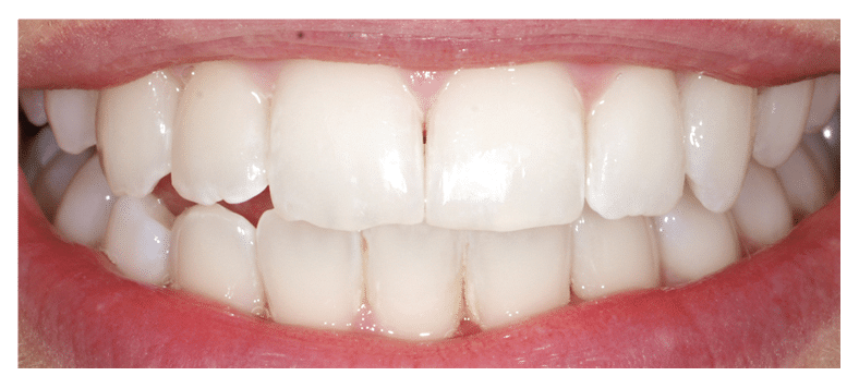 After Braces at Dental Touch