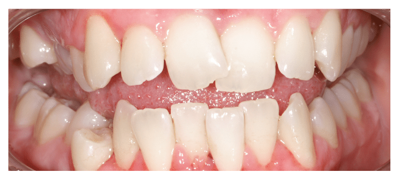 Before Braces at Dental Touch