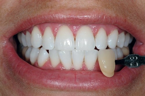 After Teeth Whitening treatment At Dental Touch Bristol