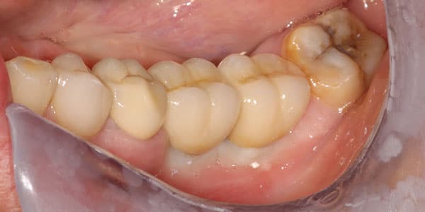 Missing back teeth replaces with 2 dental implants patient Missing back teeth replaces with 2 dental implants