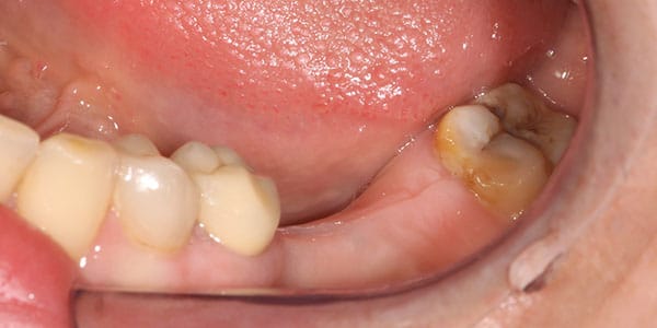 patient was Missing back teeth Missing back teeth