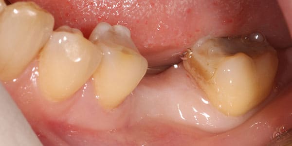 patient in Bristol missing single back tooth Missing single back tooth