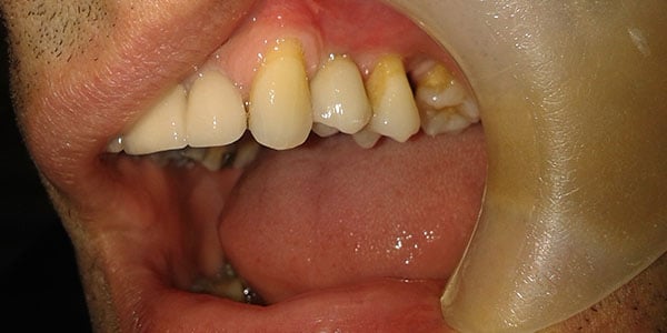 After Dental Implants in Bristol After Dental Implants in Bristol