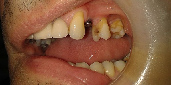 Before Dental Implants in Bristol Before Dental Implants in Bristol