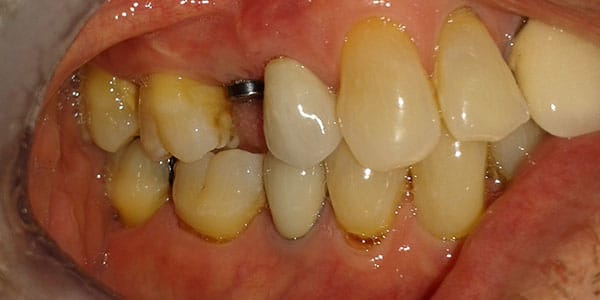 Before Dental Implants in Bristol Before Dental Implants in Bristol