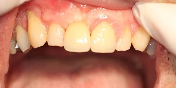 Patients missing front tooth replaced with a dental implant replaced missing front tooth with a dental implants
