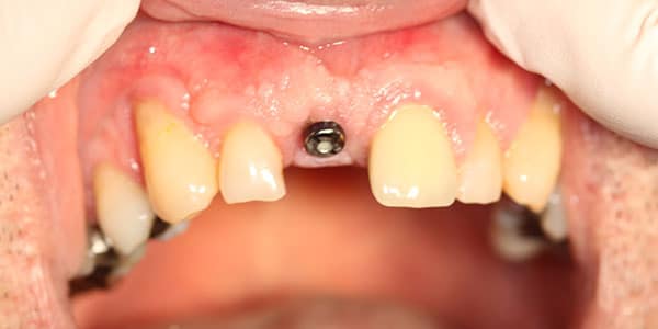 Bristol patient missing front tooth Missing front teeth