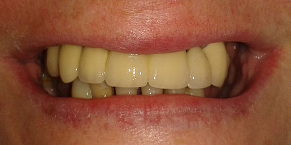 After Dental Implants placed in front missing teeth Implant dentist replaced multiple missing front teeth